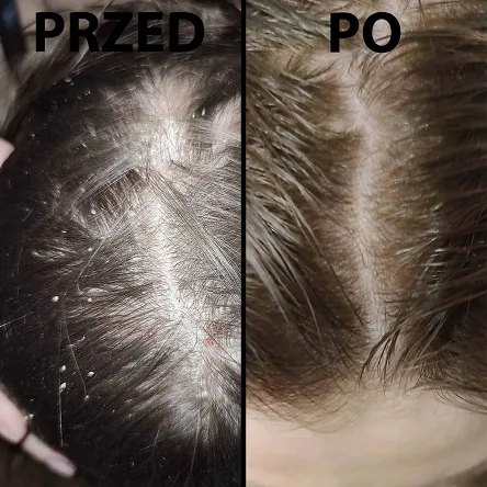 Szampon Dermz Healpsorin na łuszczycę i ŁZS 500ml Dermz 5907222288009