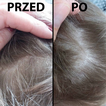 Szampon Dermz Healpsorin na łuszczycę i ŁZS 500ml Dermz 5907222288009