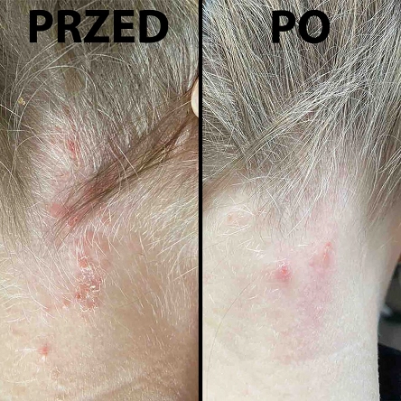 Szampon Dermz Healpsorin na łuszczycę i ŁZS 500ml Dermz 5907222288009